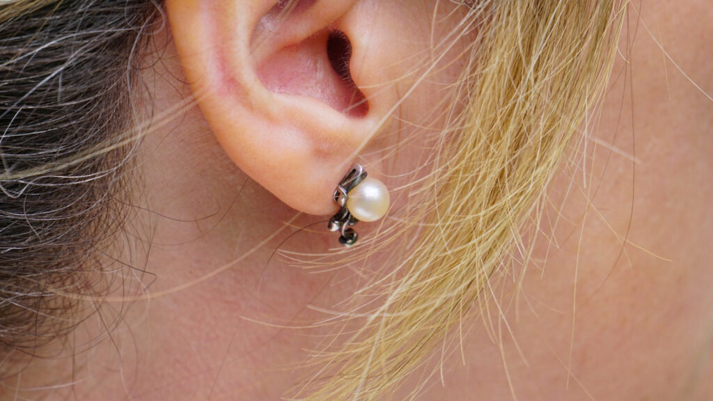 Tout savoir sur l'otoplastie : la solution aux oreilles décollées